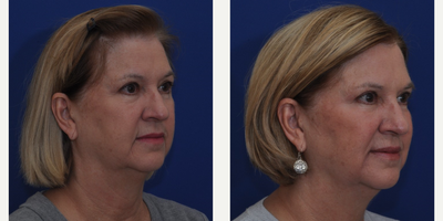 Restylane before and after photo