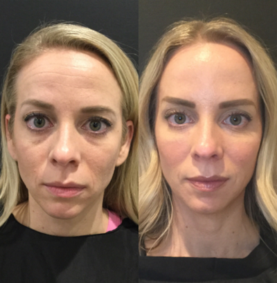 Dermal Fillers before and after photo