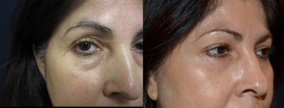 Eyelid Surgery before and after photo