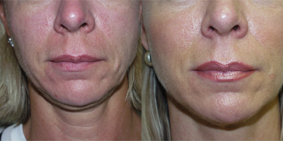 Facial Fat Transfer before and after photo