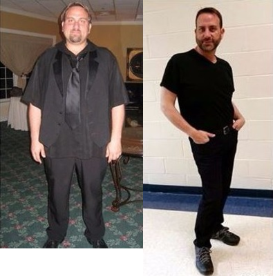 Lap Band before and after photo