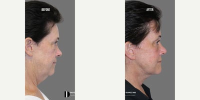 Neck Lift before and after photo