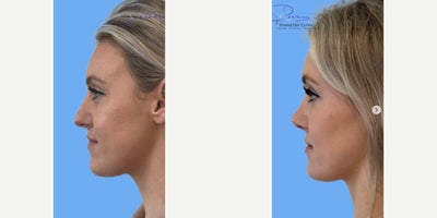 Rhinoplasty before and after photo