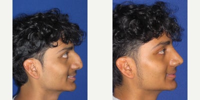 Rhinoplasty before and after photo