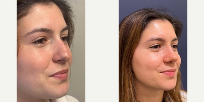 Septoplasty before and after photo