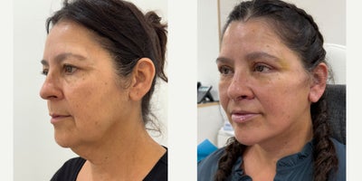 Deep Plane Facelift before and after photo