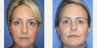 Eyelid Surgery before and after photo