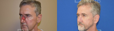 Mohs Surgery before and after photo