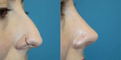 Rhinoplasty before and after photo
