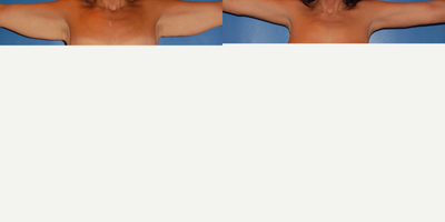 Arm Lift before and after photo
