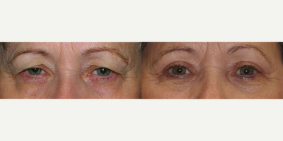 Botox before and after photo