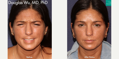Botox before and after photo