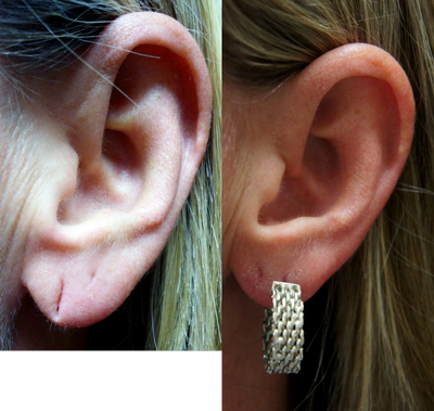 Earlobe Repair before and after photo