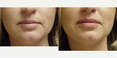 Juvederm before and after photo