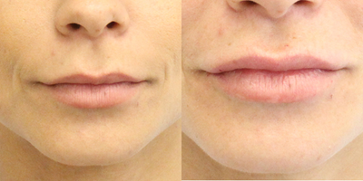 Lip Fillers before and after photo