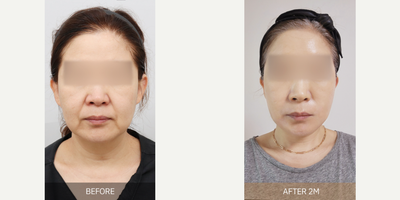 Brow Lift before and after photo