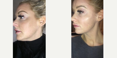 Dermal Fillers before and after photo