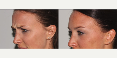 Dysport before and after photo