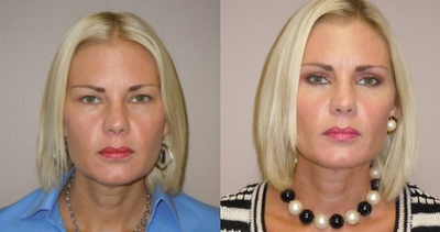 Eyelid Surgery before and after photo