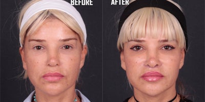 Lip Lift before and after photo