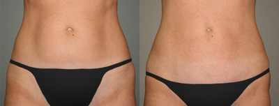 Liposuction before and after photo