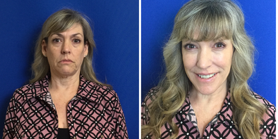 Liquid Facelift before and after photo