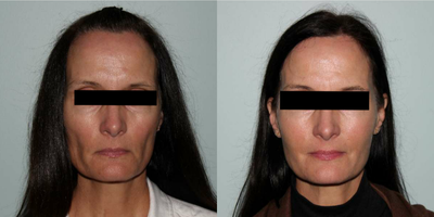 Sculptra before and after photo