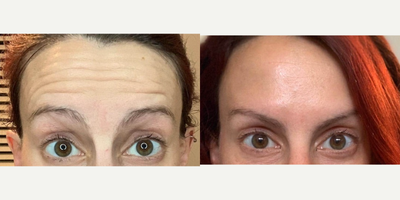 Dysport before and after photo