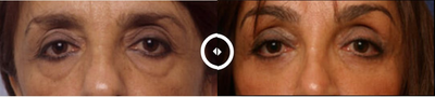 Eyelid Surgery before and after photo