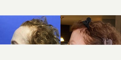 Facial Feminization Surgery before and after photo