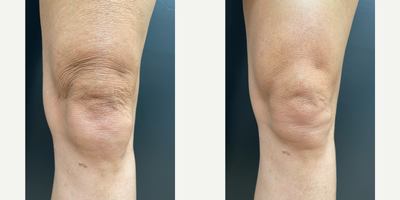 Morpheus8 before and after photo
