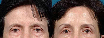 Brow Lift before and after photo