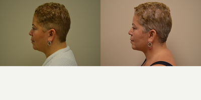 Chin Liposuction before and after photo