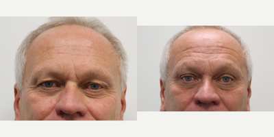 Eyelid Surgery before and after photo