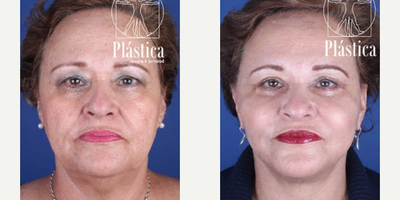 Facelift before and after photo