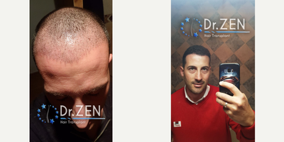 FUE Hair Transplant before and after photo