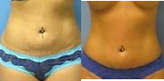 Laser Liposuction before and after photo