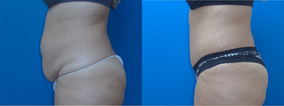 Tummy Tuck before and after photo