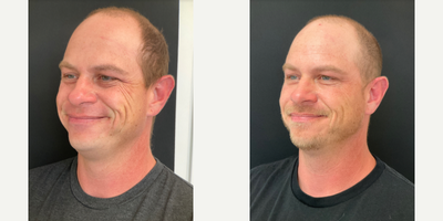 Botox before and after photo