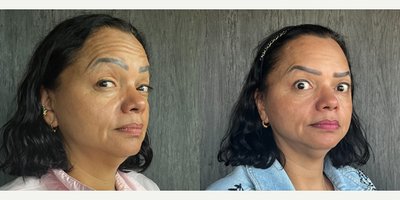 Botox before and after photo