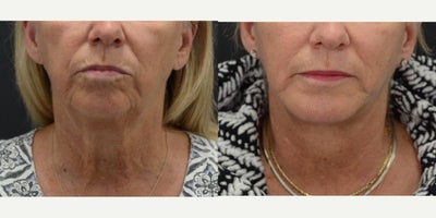 Chin Implant before and after photo