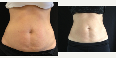 CoolSculpting before and after photo