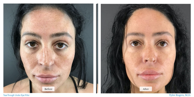 Eyelid Surgery before and after photo