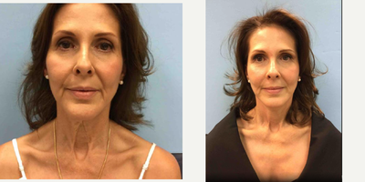Facelift before and after photo