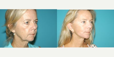 Facial Fat Transfer before and after photo