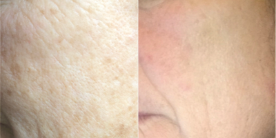 IPL before and after photo