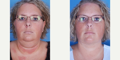 Liposuction before and after photo