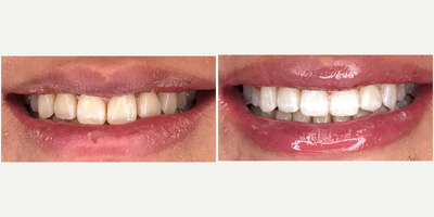Teeth Whitening before and after photo