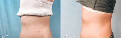 Emsculpt before and after photo