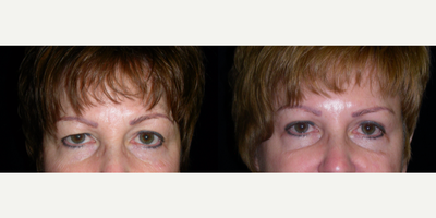 Eyelid Surgery before and after photo